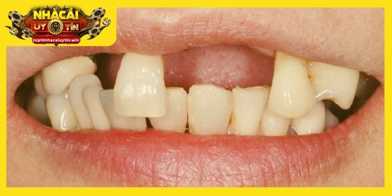 Chiêm bao thấy răng hàm trên rụng, báo hiệu thử thách trước mắt